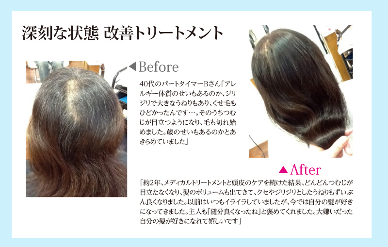 深刻な状態 改善トリートメント。40代のパートタイマーBさん「アレルギー体質のせいもあるのか、ジリジリで大きなうねりもあり、くせ毛もひどかったんです…。そのうちつむじが目立つようになり、毛も切れ始めました。歳のせいもあるのかとあきらめていました」
